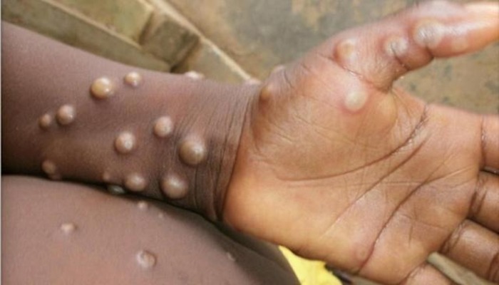 Urgent   Le Maroc d  tecte 3 cas suspects de variole du singe  minist  re  